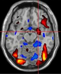 Functional magnetic resonance image of brain activity in women who recently gave birth.